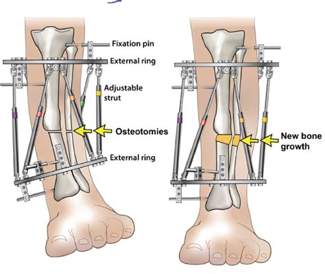 The Limb Lengthening and Deformity Correction Program | Elaj Medical ...