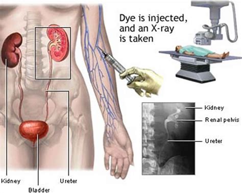 Image result for Normal Intravenous Pyelogram