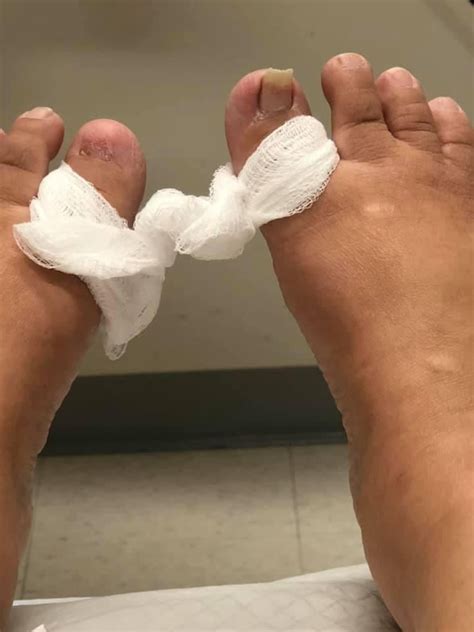 Full Toenail Extraction 的图像结果
