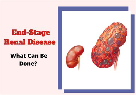 What Is Treatment Kidney Disease at Sofia Goldman blog