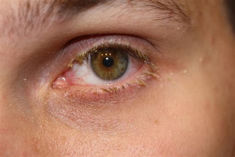Bildergebnis für blepharitis ansteckend