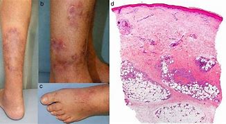 Image result for periarteritis