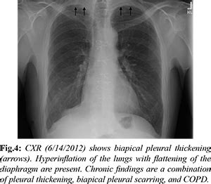 Pleuroparenchymal Fibroelastosis following Asbestos Exposure