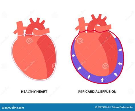 How Dangerous Is Fluid Around The Heart