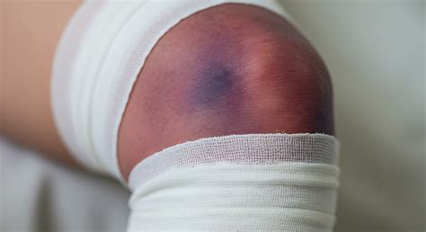 Back Of Knee Bruised