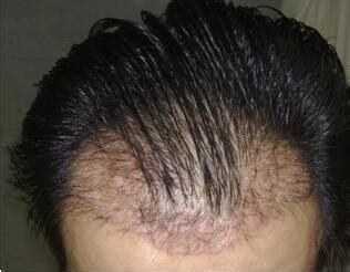 植发一般多少钱，植发的缺点有哪些 – 生发垂直网