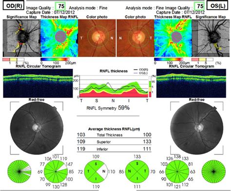 Image result for Optical Coherence Tomography Tutorial