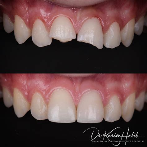 Composite Veneers Sydney | Dental Bonding Sydney - Dentist Ryde | Gladesville | Putney | North Ryde