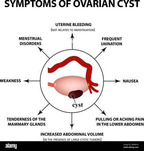 Location Of Pain Ovarian Cyst