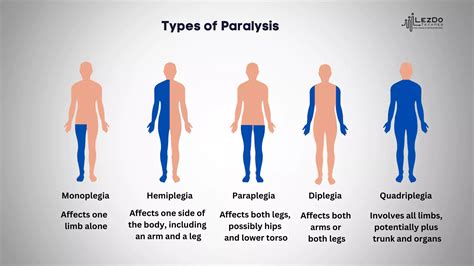 Types of Paralysis: A Detailed Look at Mobility Impairments
