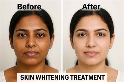 skin-lightening-before-after-result-india. | Dr Reema Arora