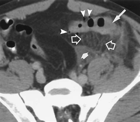 Disproportionate Fat Stranding: A Helpful CT Sign in Patients with ...