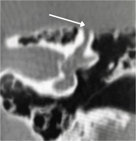 Brazilian Society of Otology task force – Otosclerosis: evaluation and treatment | Brazilian ...