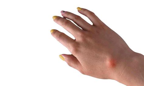 Cystic Hygroma: Meaning, Symptoms, Causes, Diagnosis and Treatment