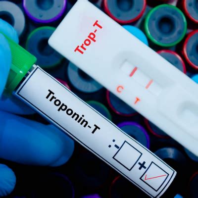 ECG or Troponin—Which Comes First? Understanding the Diagnostic Lines ...