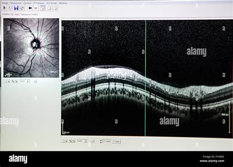 Image result for Optical Coherence Tomography Tutorial