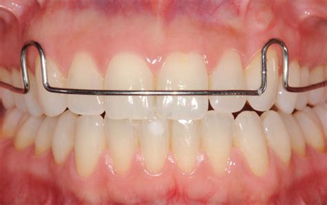 Image result for Retainer Problems