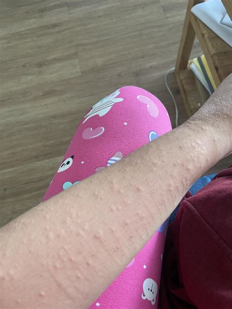 What are these Itchy bumps? (Tw: healed scars) : r/DermatologyQuestions