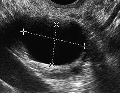 Ovarian Cancer Ultrasound