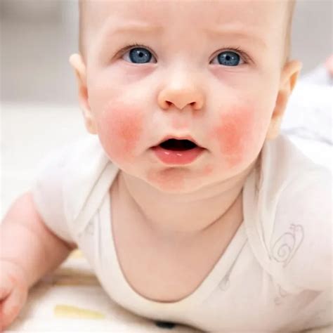 Frequent and Infrequent Bathing Regimens in Pediatric Atopic Dermatitis ...