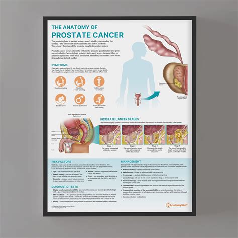Anatomy of Prostate Cancer Poster | Anatomy Stuff – AnatomyStuff
