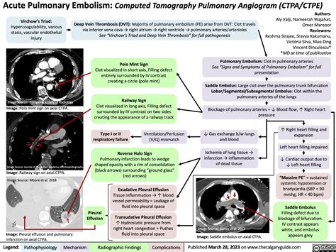 Acute Pulmonary Embolism: Computed Tomography Pulmonary Angiogram (CTPA/CTPE) | Calgary ...