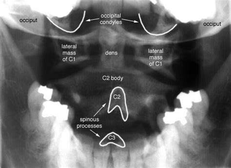 Image result for Alien Back Open