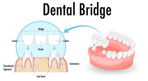 Dental Crown in KPHB, Kukatpally, Hyderabad - Dental Bridges in ...