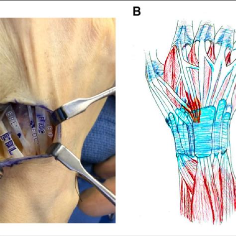 Image result for Extensor Digitorum Communis Surgery