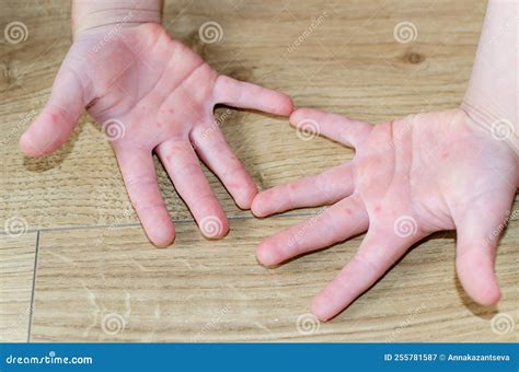 Age Spots On Hands. They Are Brown, Gray, Or Black Spots And Also Called Liver Spots, Senile ...