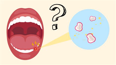 Canker Sore On Tonsil Causes