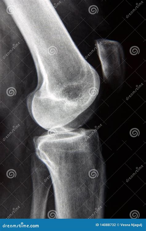 Normal Knee xray stock photo. Image of radiology, hospital - 14088732