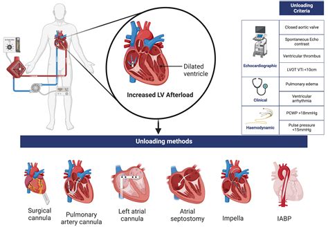 Unloading the Left Ventricle in Venoarterial ECMO: In Whom, When, and How? | Circulation