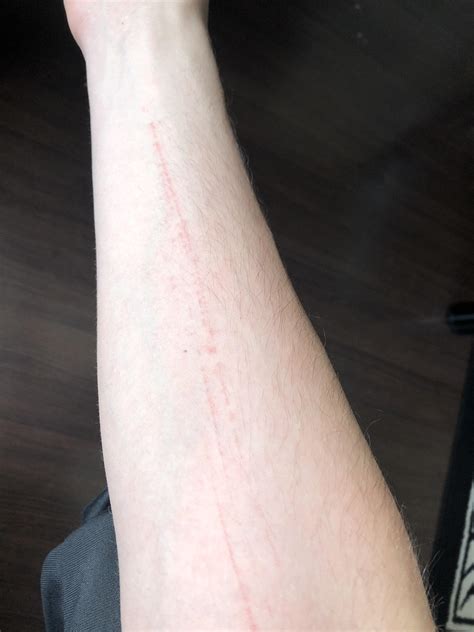 What are these thin red lines on my forearm? Noticed them like 6 hours ...