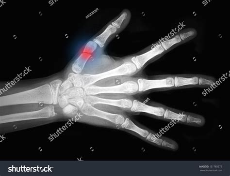 Broken Index Finger X Ray