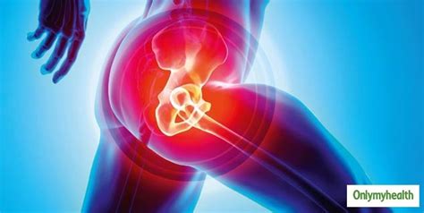 Understanding Avascular Necrosis (AVN) and Ayurvedic Treatment Options