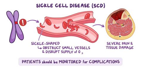 Sickle cell disease: Video & Meaning | Osmosis