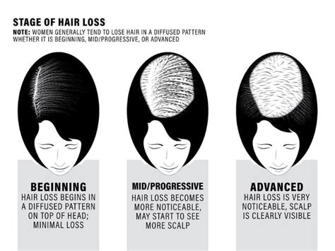 Stages of Hair-loss - Image