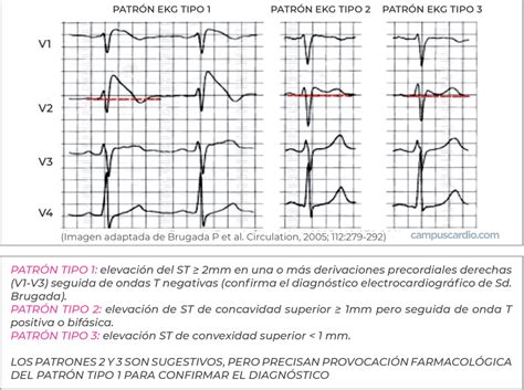 Patrón EKG del síndrome de Brugada - CampusCardio