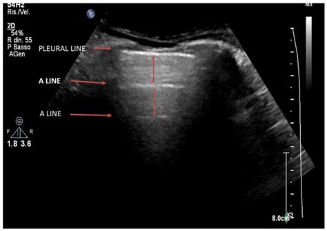 Infectious Pneumonia and Lung Ultrasound: A Review
