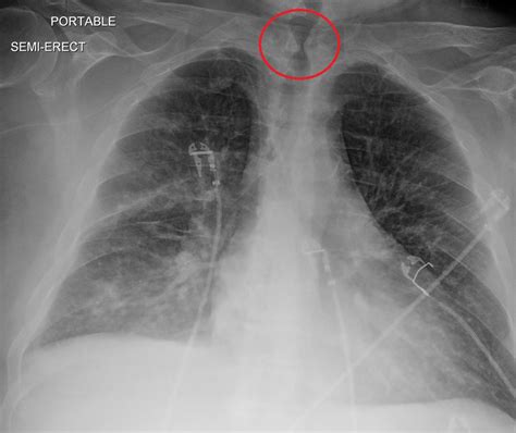 Tracheal Stenosis Treatment in Delhi | Holy Family Hospital, India