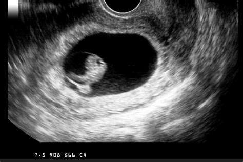 Why an Obstetrician Might Order a Seven-Week Ultrasound