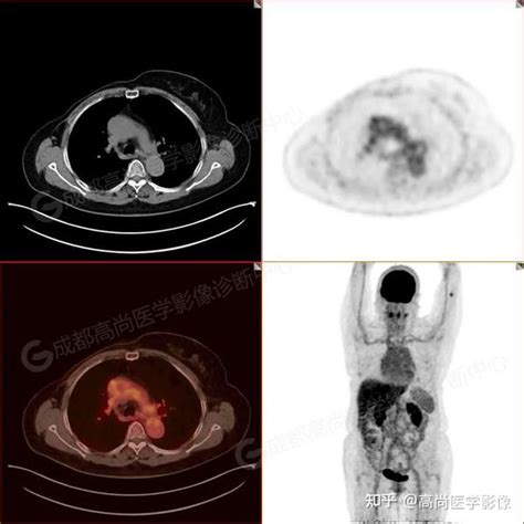乳腺癌术后肝多发转移一例【PET/CT-MR多模态显像】 - 知乎