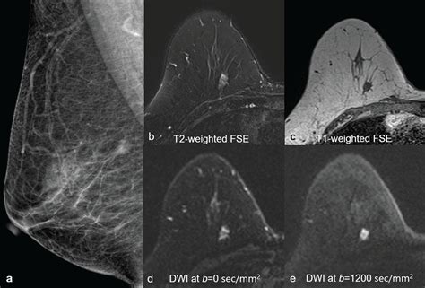 Diffusion MRI as a Stand-Alone Unenhanced Approach for Breast Imaging and Screening | Radiology Key