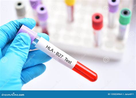 Blood Sample Tube for HLA-B27 Test Stock Photo - Image of arthritis ...