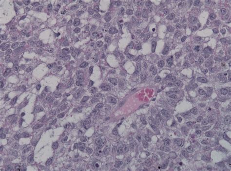 Endodermal sinus tumor; Yolk Sac Tumor