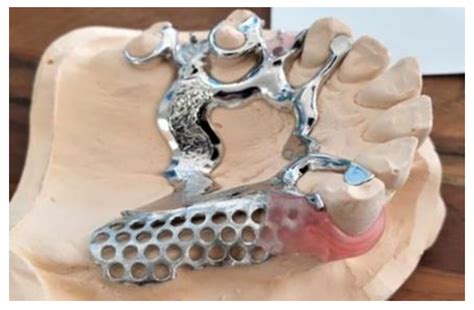 Construction of a Removable Partial Denture (RPD): Comparison between ...
