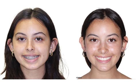 Triple jaw surgery 5 — Elite Oral and Facial Surgery- Long Island Oral and Maxillofacial Surgeon