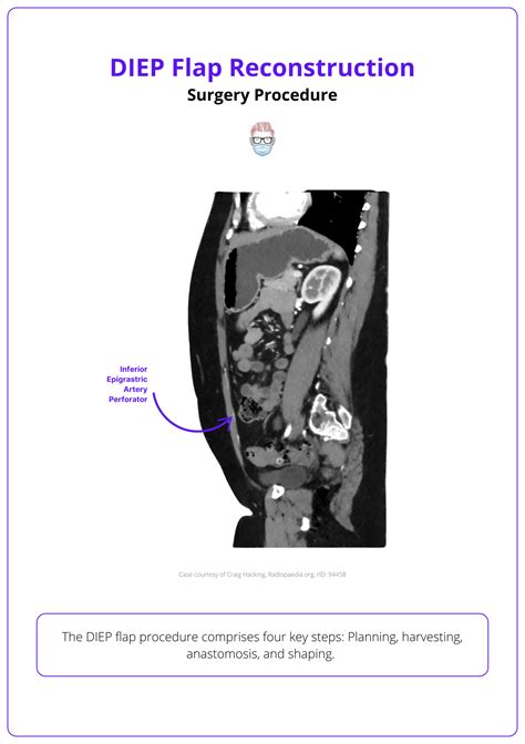 DIEP Flap Reconstruction: Anatomy, Key Surgical Steps, & Complications