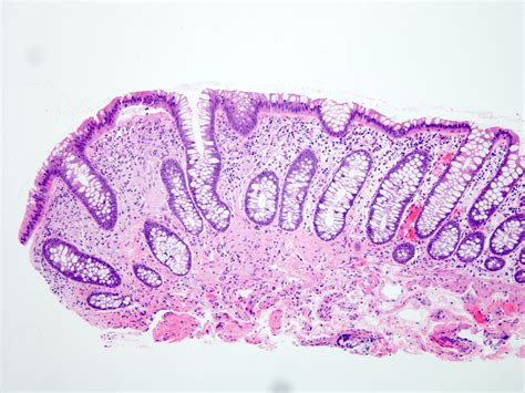 Granular Cell Tumor Histology Granules In Granular Cell Lesions Of The